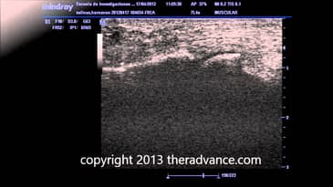 Diagnostic Ultrasound Pre and Post IASTM