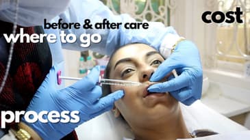 My Lip Filler Experience 💉👄 | How much time it took, price, why I did it | VLOG