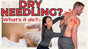 What is Dry Needling? When is it Beneficial?
