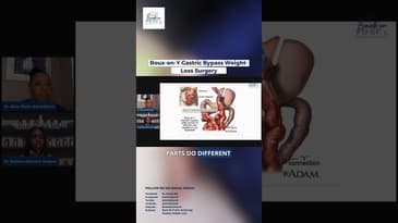 Roux-En-Y Gastric Bypass Weight Loss Surgery #weightloss #youtubeshorts #shorts