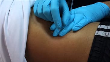 Dry Needling to Quadratus Lumborum