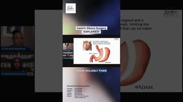Gastric Sleeve Surgery: EXPLAINED! #gastricsleeve #youtubeshorts #shorts