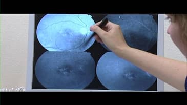 Gezonde Zorg: Maculadegeneratie Slingeland Ziekenhuis