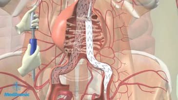 Operatie aneurysma van de buikslagader (EVAR-procedure)