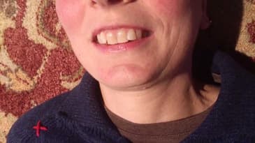 TMD: Mandible Deviation