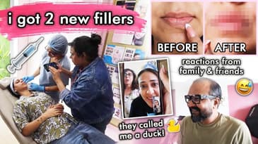 I got a LIP FILLER (again) & CHIN FILLER!