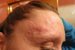 hives