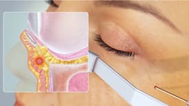 AccuTite Recovery: From Downtime to Final Results Explained